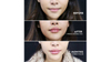 Reclaim Your Youth with Juvederm Dermal Fillers – Smooth, Plump, And Natural Results 
