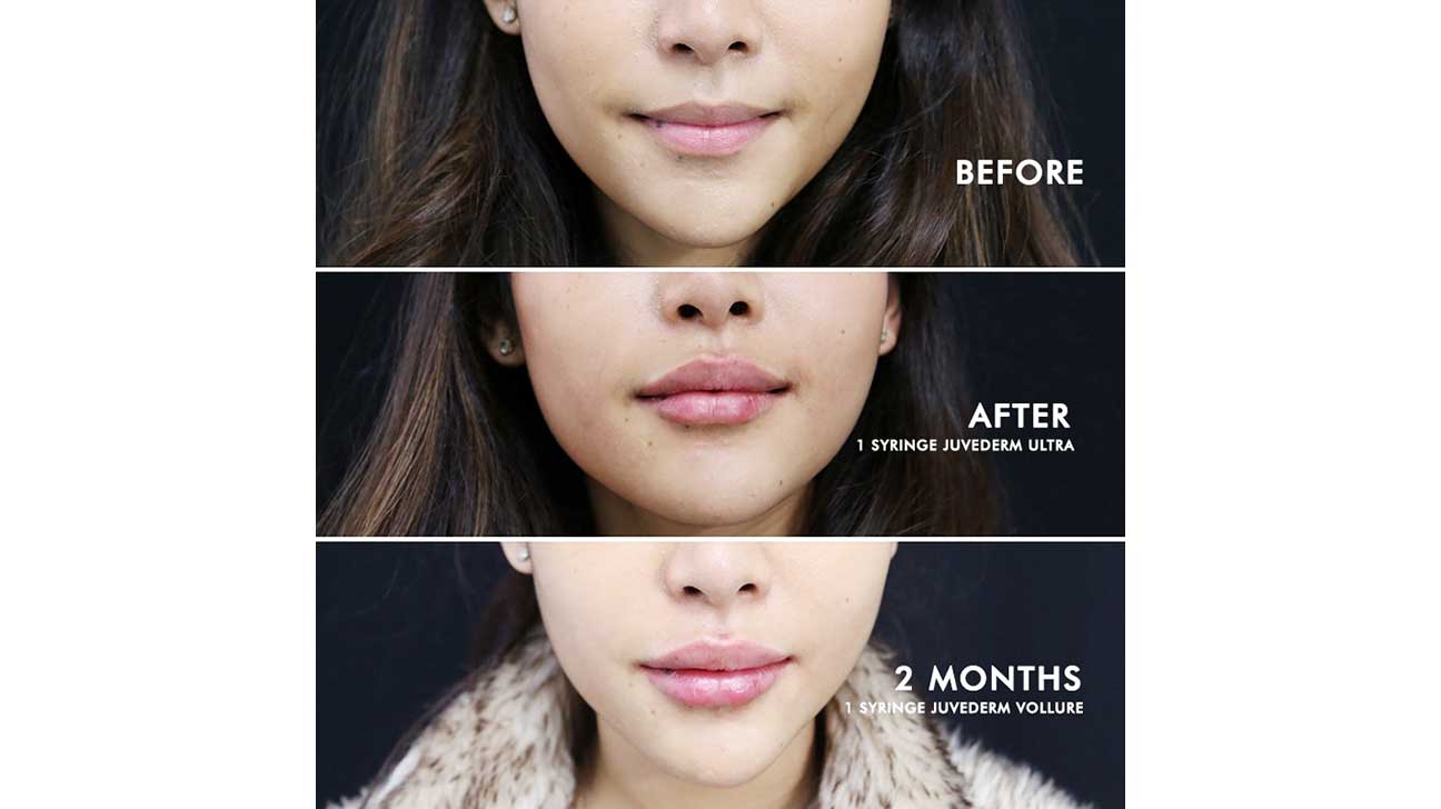 juvederm-1296x728-slide1