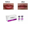 Liporase Dissolve Hyaluronic Acid Hyaluronidase Liporase Injection To Remove Dermal Filler