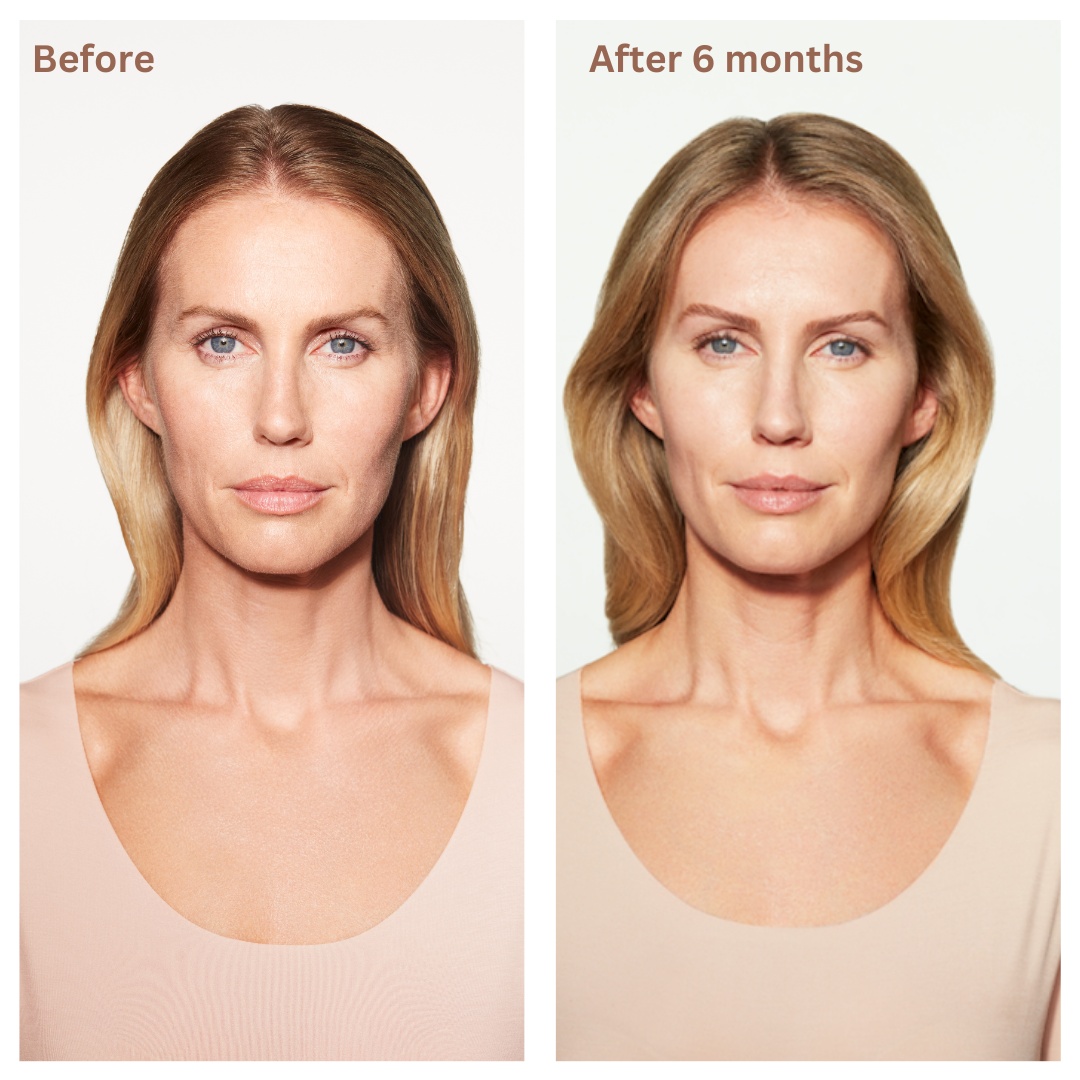 Before-After-Sculptra_副本.jpg